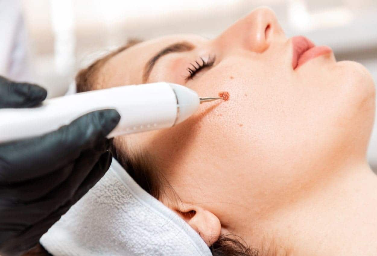 Benefits of Ephelides Treatment Eastleigh 
