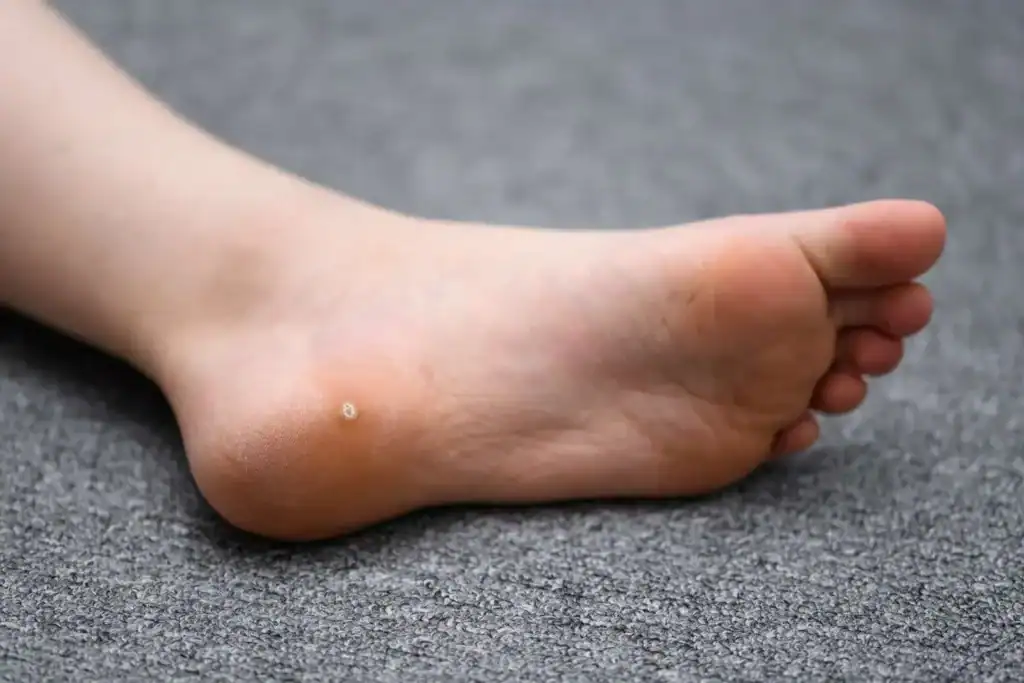 Image of verruca on the bottom of the foot that able to be treated with Cryotherapy Eastleigh 