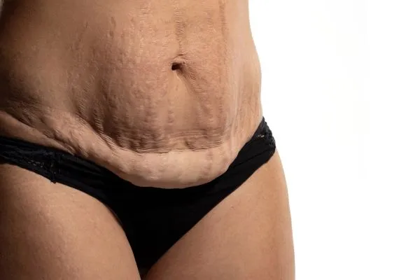 The science behind skin tightening Eastleigh  picture of a woman's sagging skin on the stomach