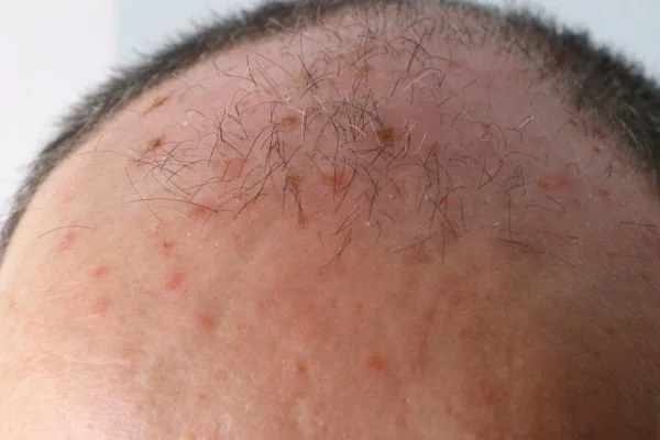 Actinic Keratoses Eastleigh 
