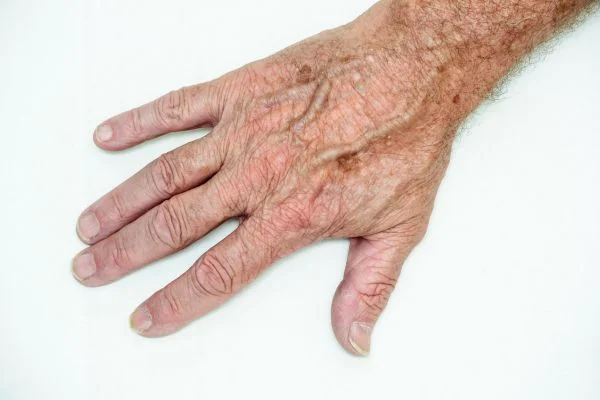 age spot removal Eastleigh 
