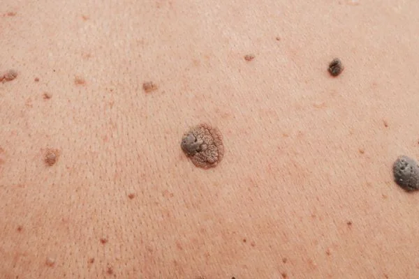 Benign Moles Eastleigh 