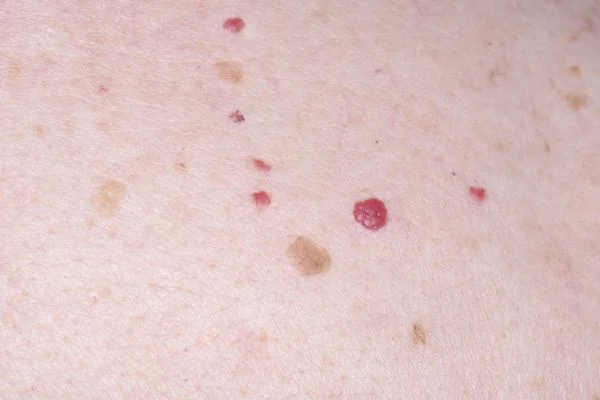 Cherry Angiomas Eastleigh 