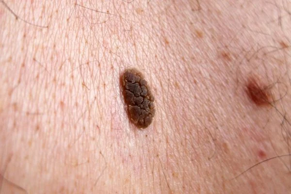 Seborrhoeic Keratoses removal Eastleigh 