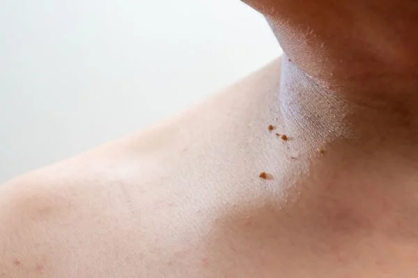skin tag removal Eastleigh 